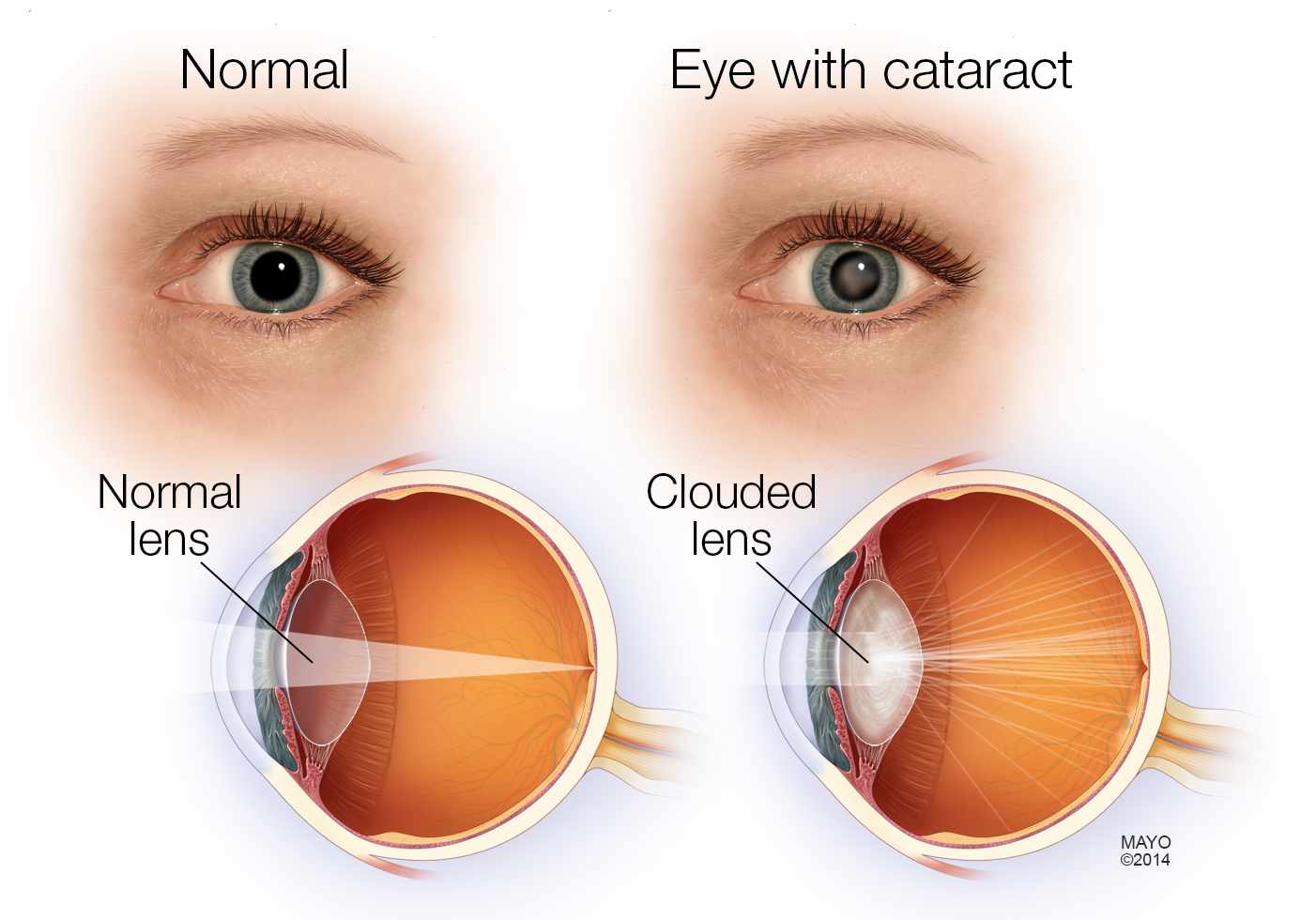 normal eye cataract